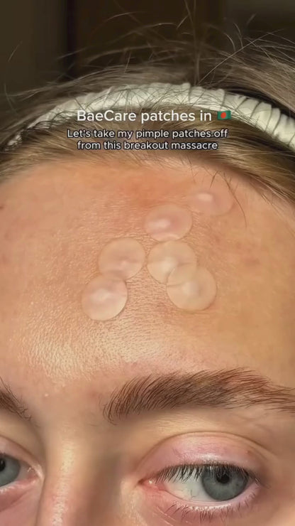 Acne Pimple Patch (72 Pieces) 2 Month Course.